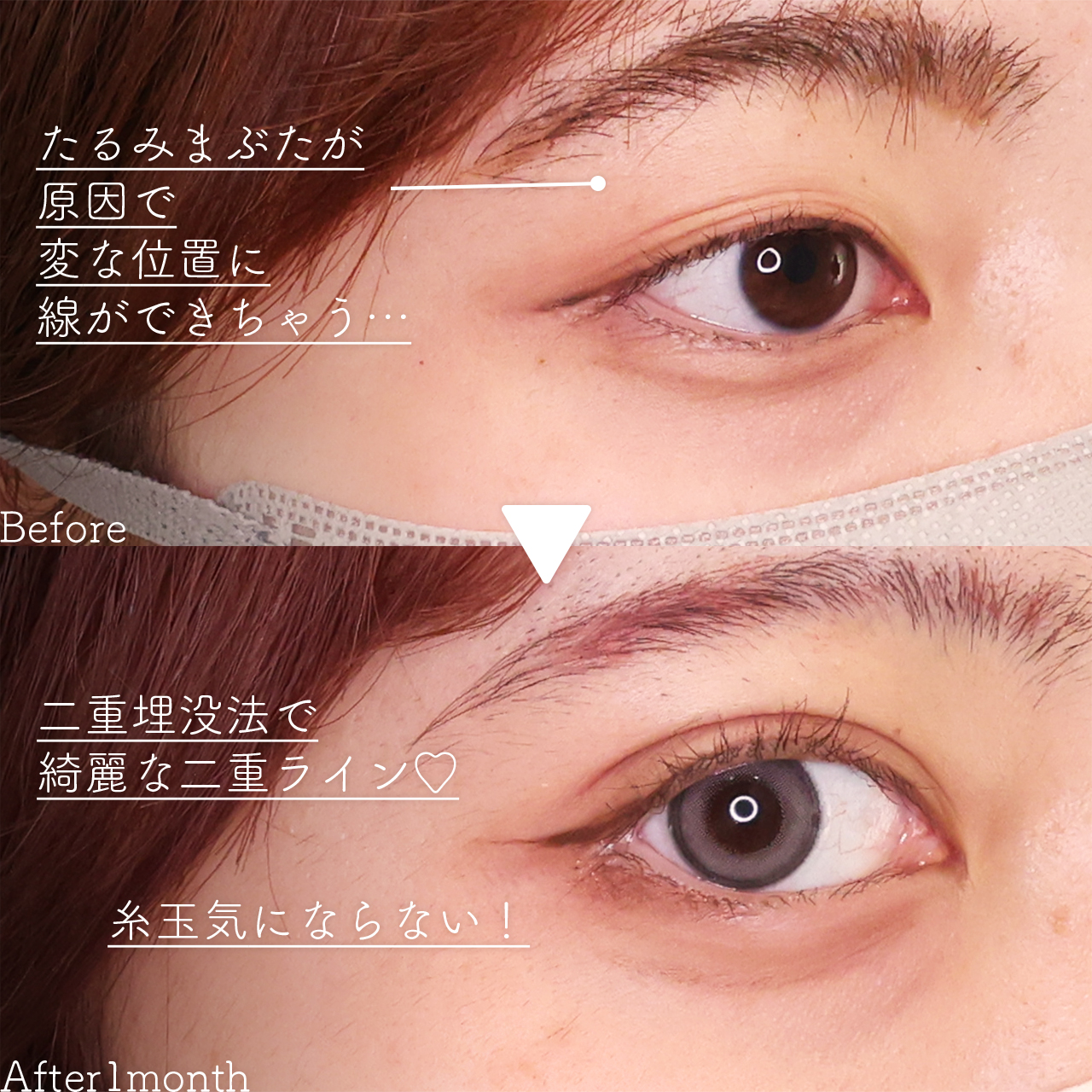 クイックコスメリングの症例写真 施術前後 