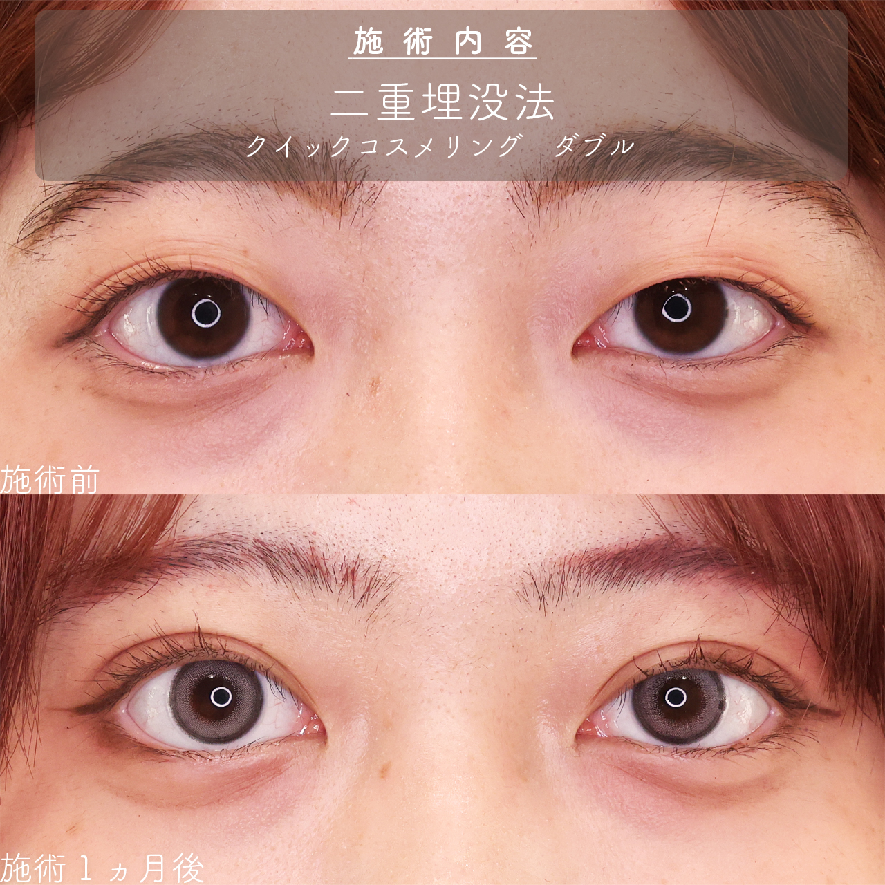 クイックコスメリングの症例写真 施術前後 
