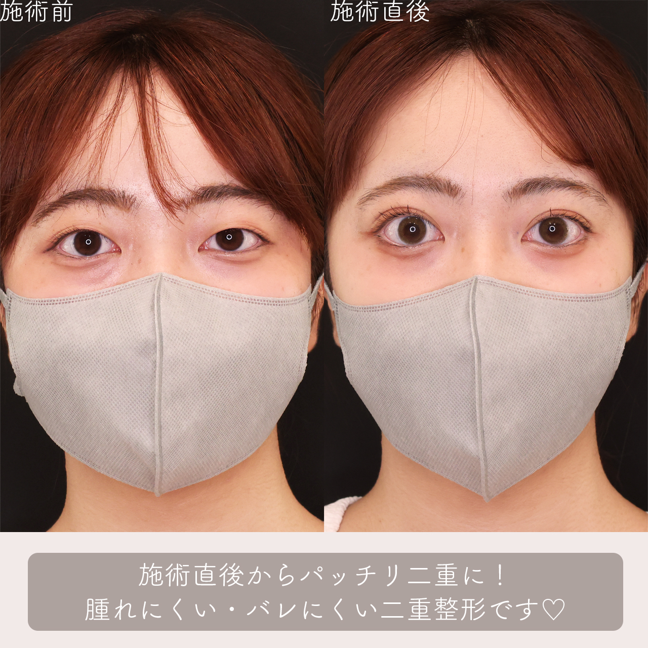 クイックコスメリングの症例写真 施術前後 