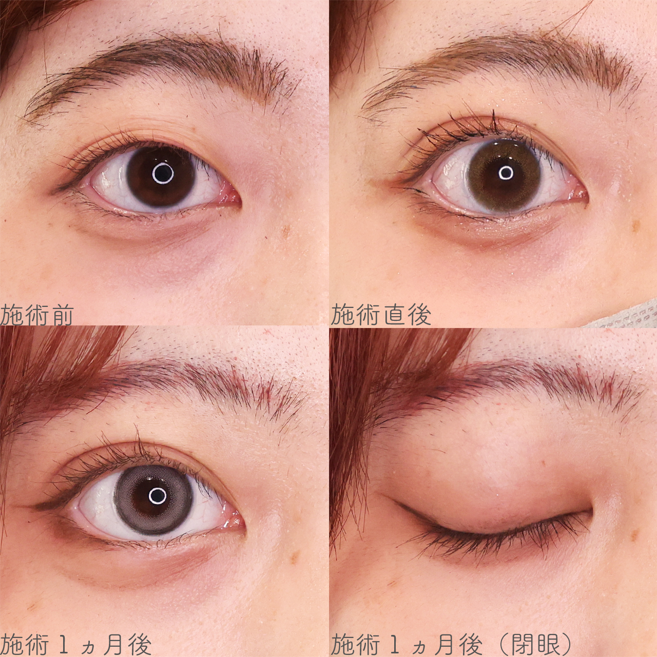 クイックコスメリングの症例写真 施術前後 