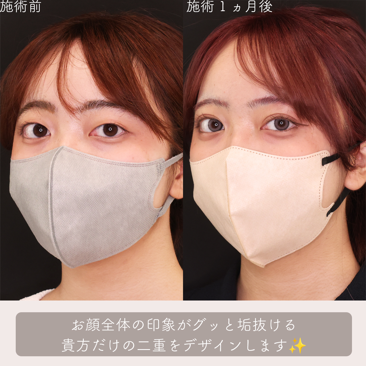 クイックコスメリングの症例写真 施術前後 