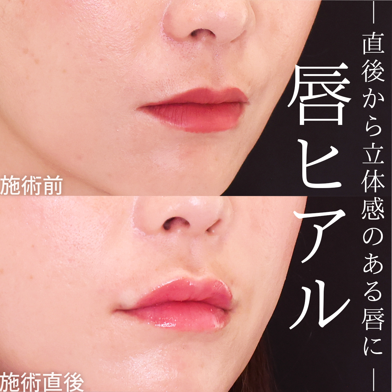 ヒアルロン酸注射：その他の症例写真 施術前後 