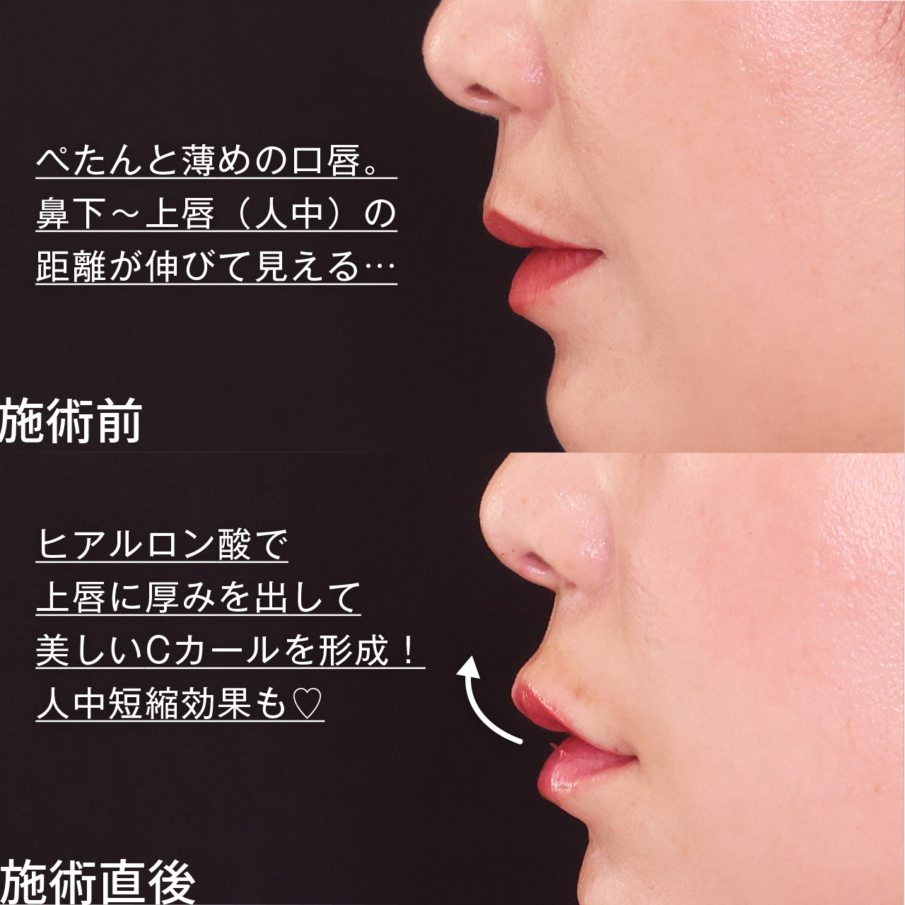 ヒアルロン酸注射：その他の症例写真 施術前後 