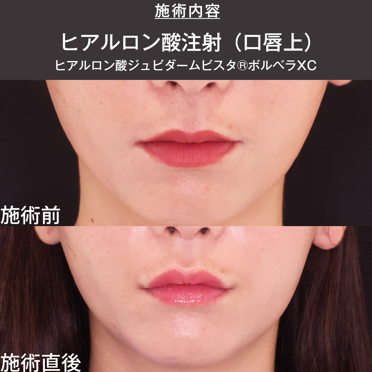 ヒアルロン酸注射：その他の症例写真 施術前後 