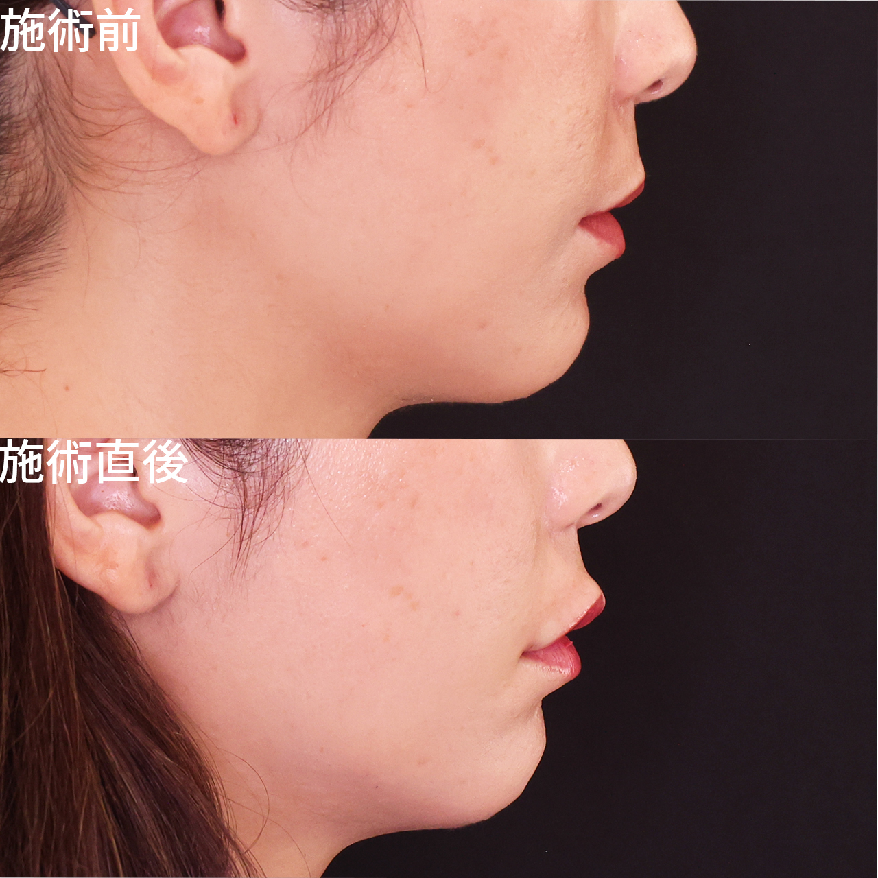 ヒアルロン酸注射：その他の症例写真 施術前後 