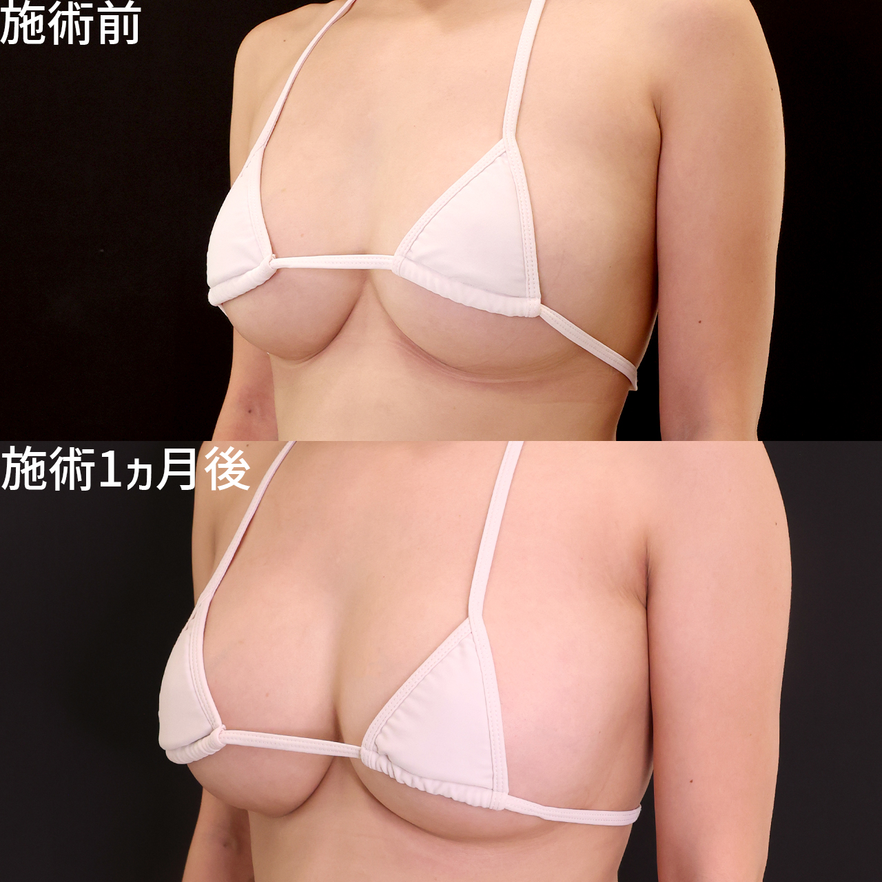 《シリコンバッグ豊胸》バッグ入れ替えでさらにサイズアップ!美しいバスト形成はDr.森