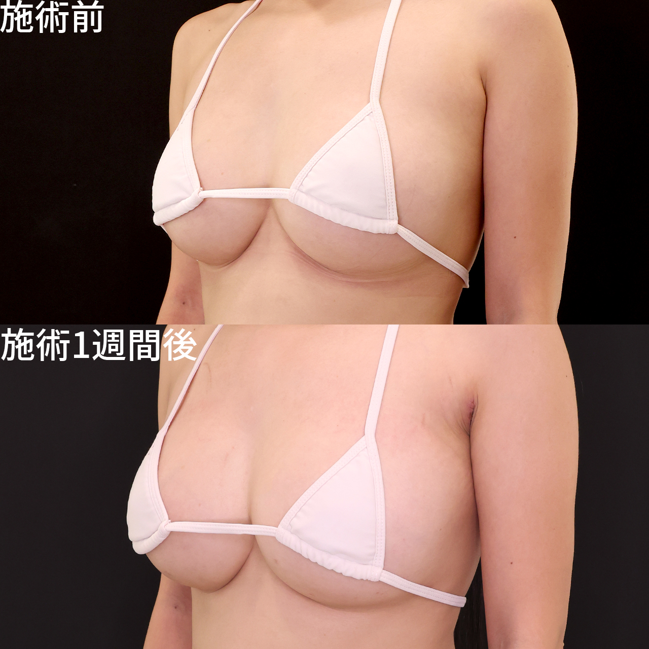 シリコンバッグ豊胸（人工乳腺バッグ）の症例写真 施術前後 