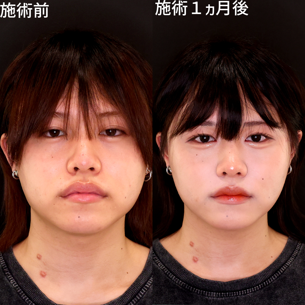 お顔のフルコースで輪郭スッキリ！Dr.森の垢抜け小顔術