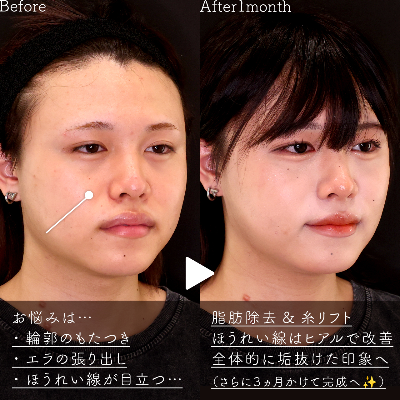 小顔整形｜パーフェクトフェイスライン/TAC式 ツヤ肌コラーゲンリフト®/ジョールファット除去の症例写真 施術前後 