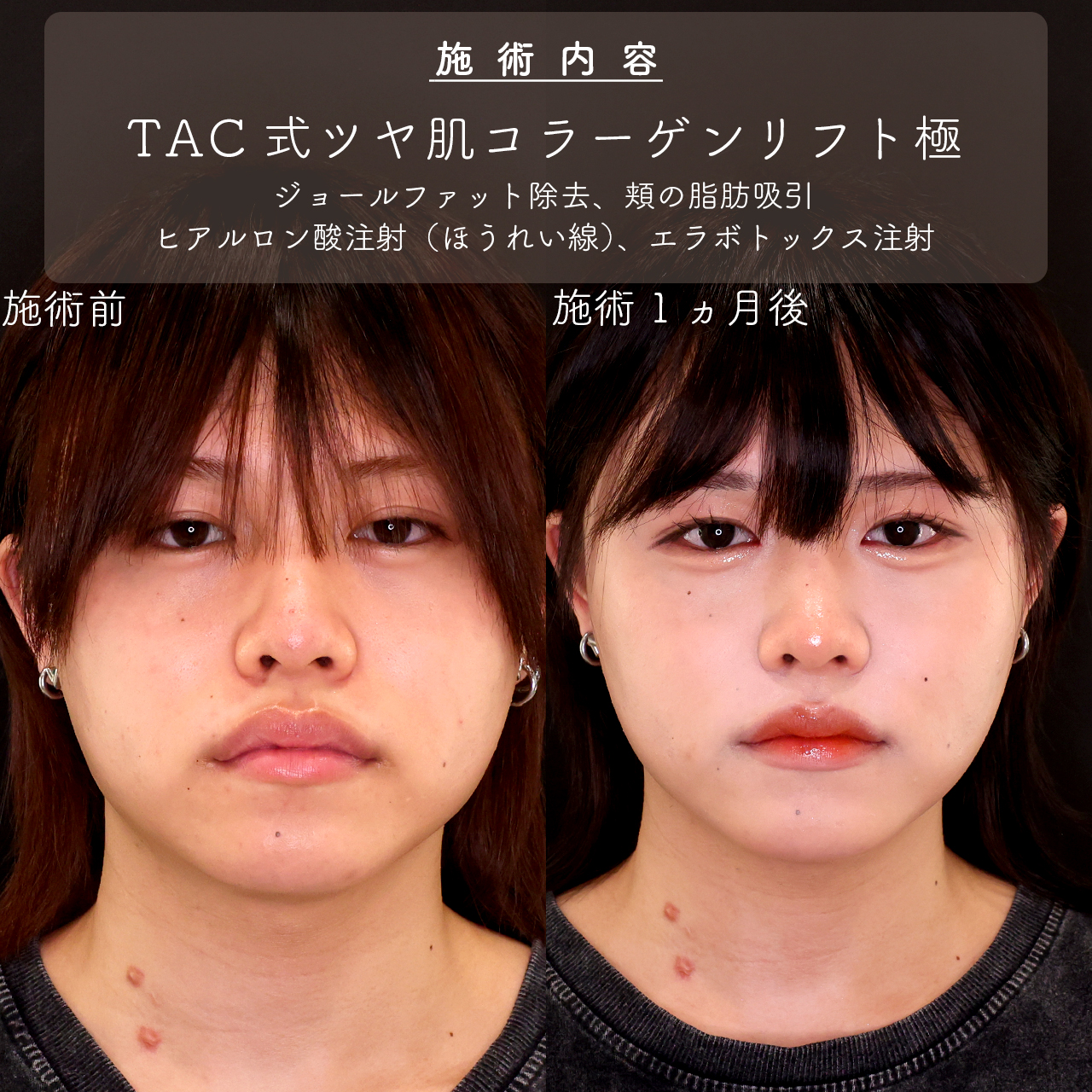 小顔整形｜パーフェクトフェイスライン/TAC式 ツヤ肌コラーゲンリフト®/ジョールファット除去の症例写真 施術前後 