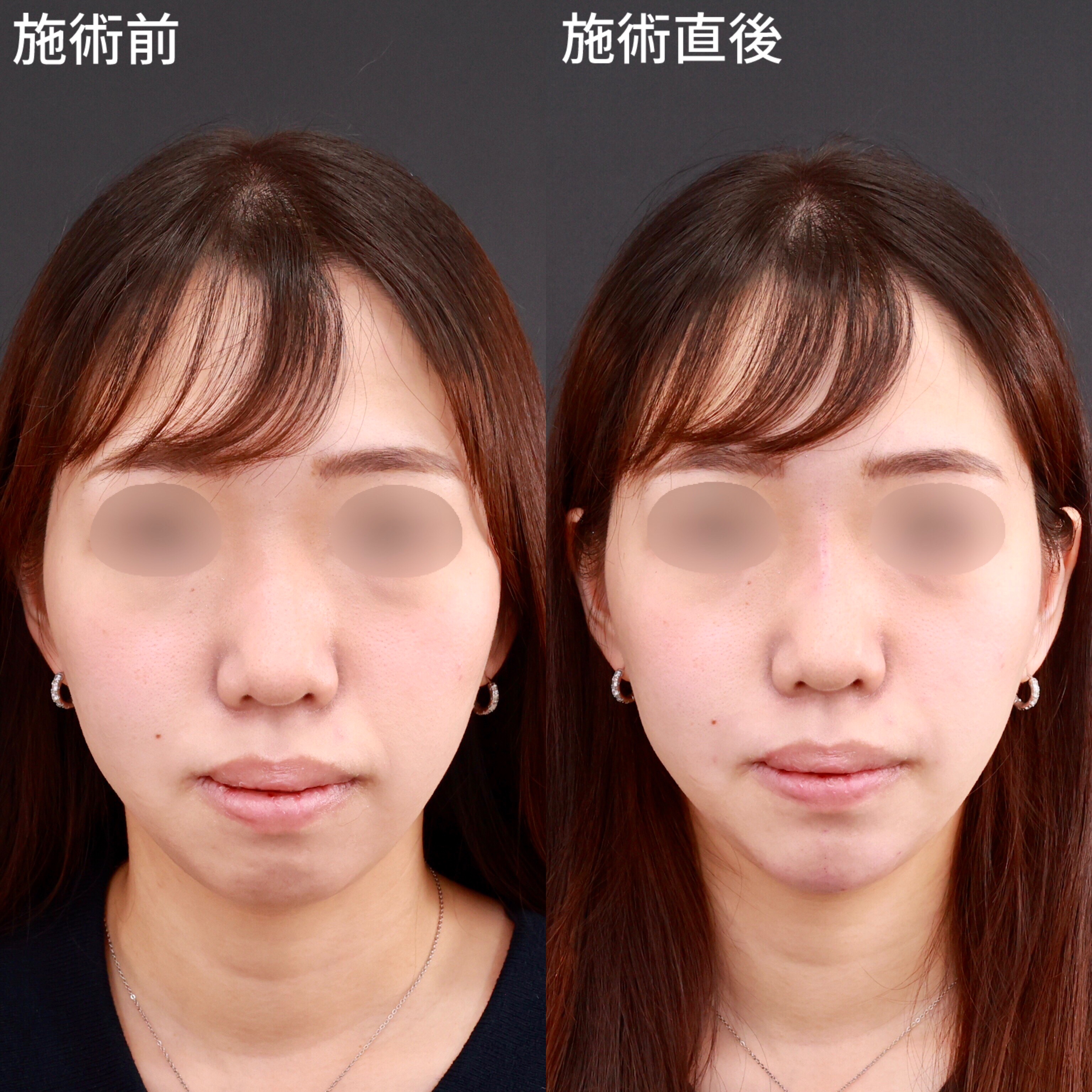 【ヒアルロン酸注射】ダウンタイムも少なく施術直後から垢抜け！