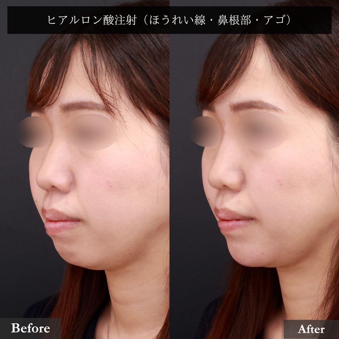 ほうれい線のヒアルロン酸注射/顎のヒアルロン酸注射/鼻のヒアルロン酸注射の症例写真 施術前後 
