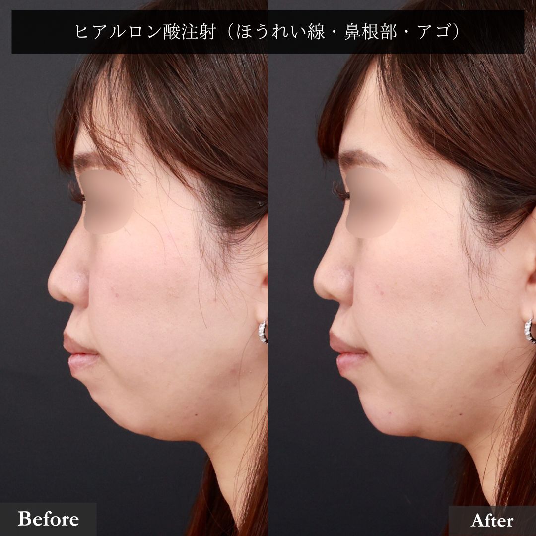 ほうれい線のヒアルロン酸注射/顎のヒアルロン酸注射/鼻のヒアルロン酸注射の症例写真 施術前後 
