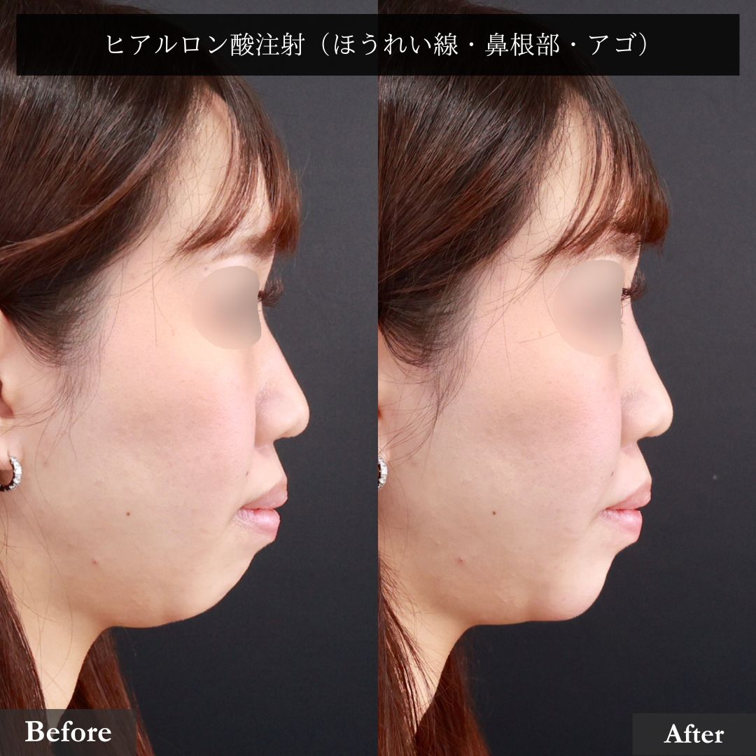 ほうれい線のヒアルロン酸注射/顎のヒアルロン酸注射/鼻のヒアルロン酸注射の症例写真 施術前後 