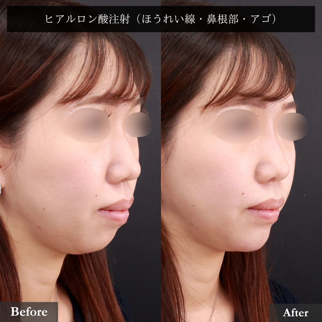 ほうれい線のヒアルロン酸注射/顎のヒアルロン酸注射/鼻のヒアルロン酸注射の症例写真 施術前後 