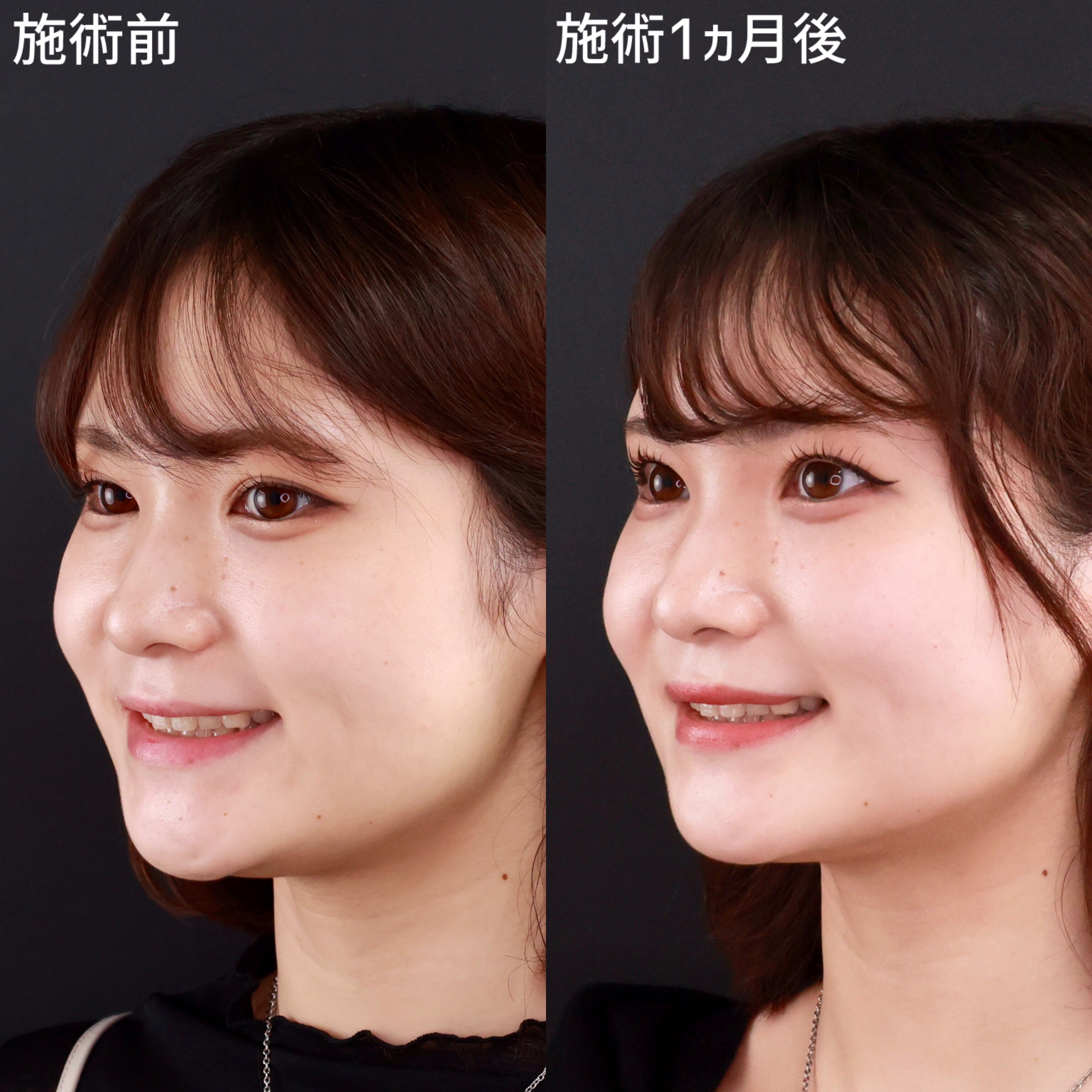 【小顔整形】お顔の余白をなくして理想のフェイスラインに