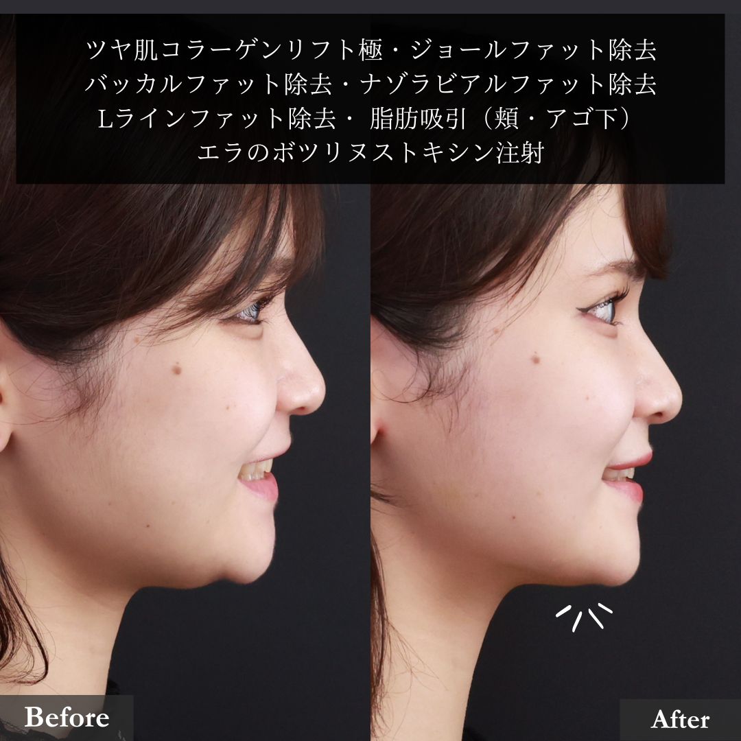 TAC式 ツヤ肌コラーゲンリフト®/バッカルファット除去/ジョールファット除去の症例写真 施術前後 