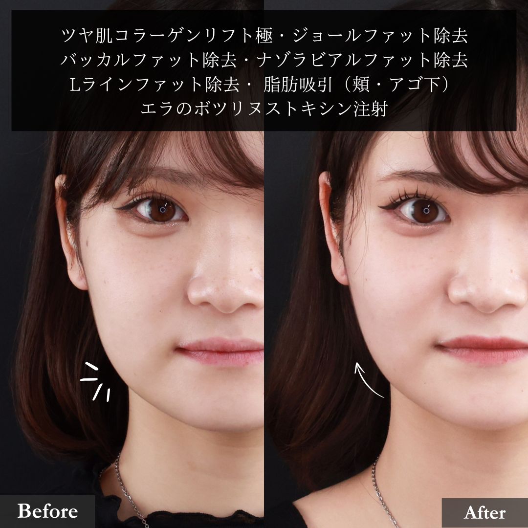 TAC式 ツヤ肌コラーゲンリフト®/バッカルファット除去/ジョールファット除去の症例写真 施術前後 