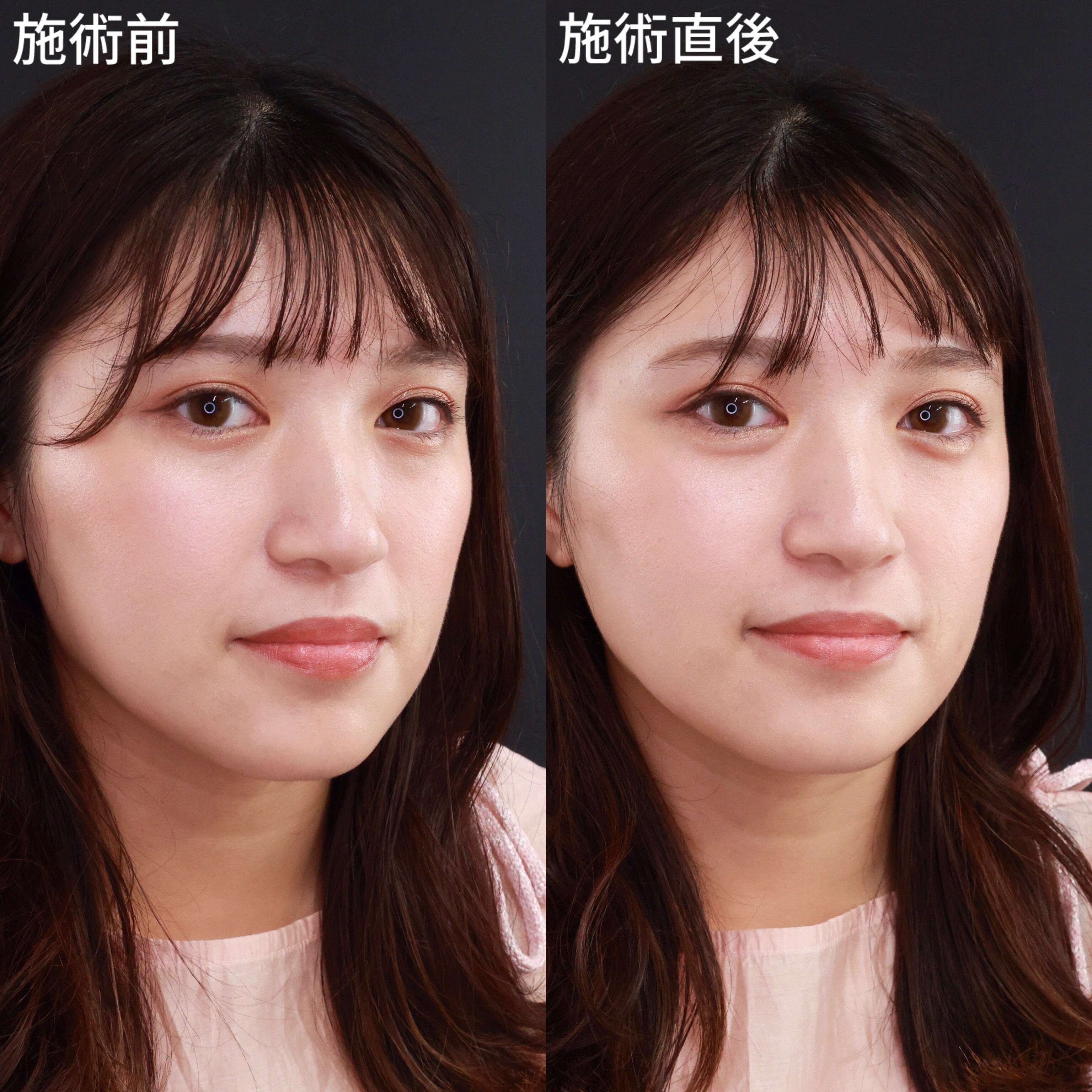 涙袋形成（ヒアルロン酸注射）の症例写真 施術前後 