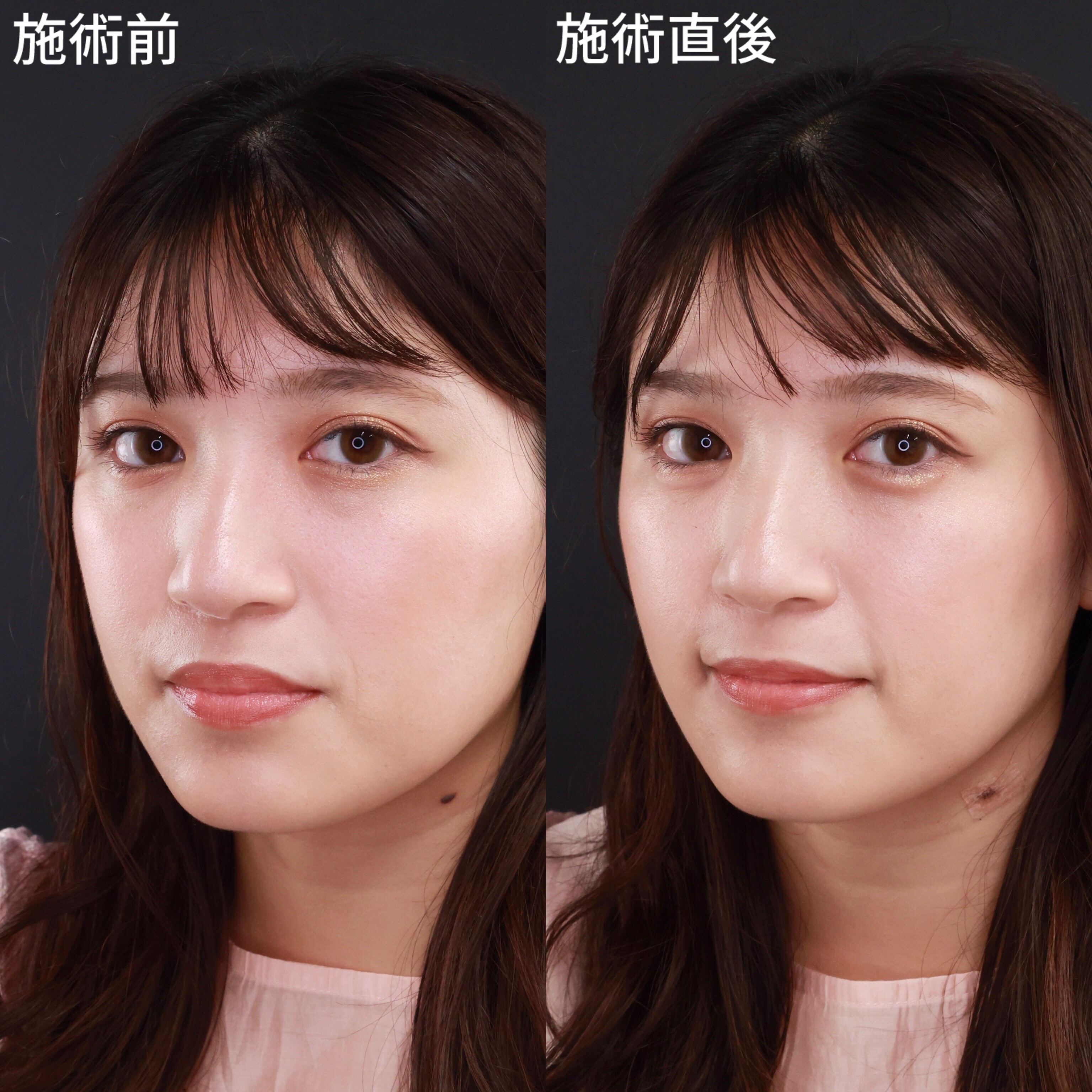 【ヒアルロン酸注射】ぷっくり涙袋で可愛い目元！中顔面短縮効果も◎