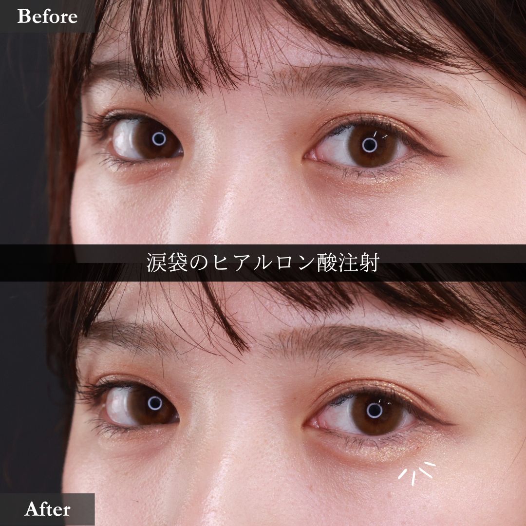 涙袋形成（ヒアルロン酸注射）の症例写真 施術前後 