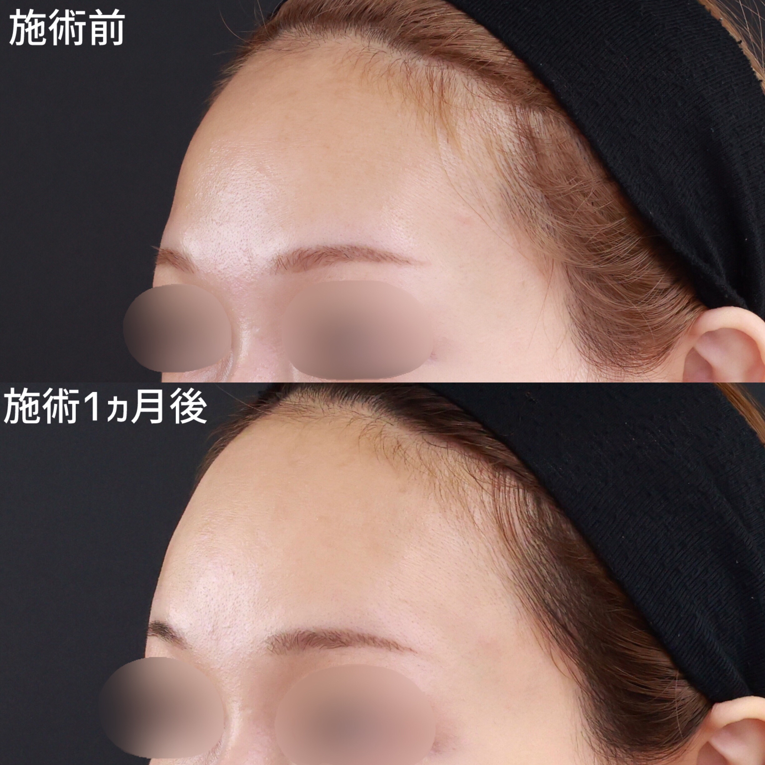 おでこの脂肪注入(オルチャンデコ形成)の症例写真 施術前後