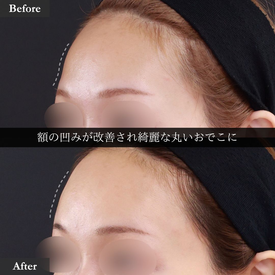 おでこの脂肪注入(オルチャンデコ形成)の症例写真 施術前後