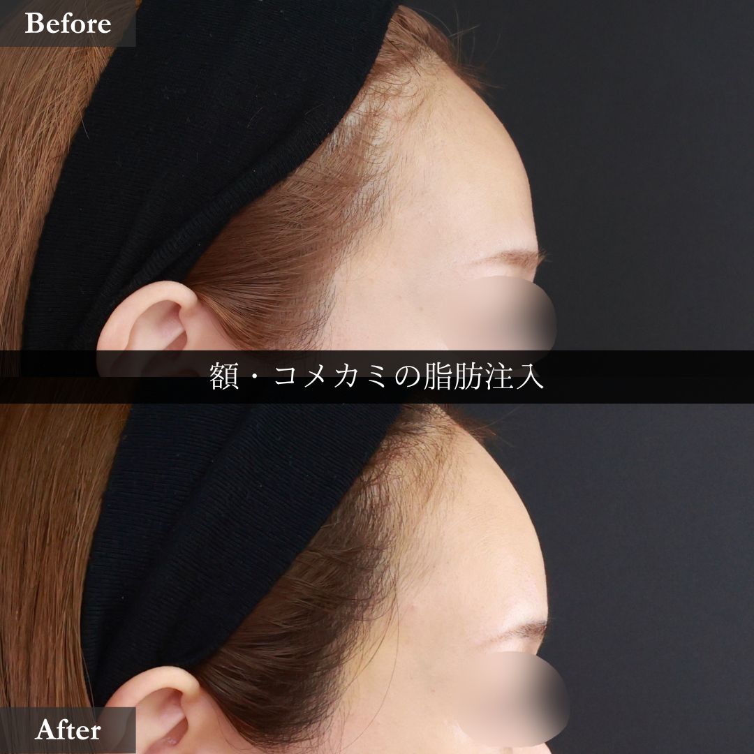 おでこの脂肪注入(オルチャンデコ形成)の症例写真 施術前後
