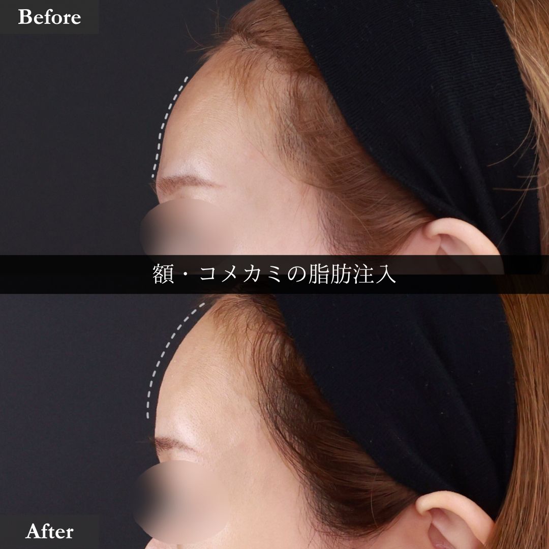 おでこの脂肪注入(オルチャンデコ形成)の症例写真 施術前後