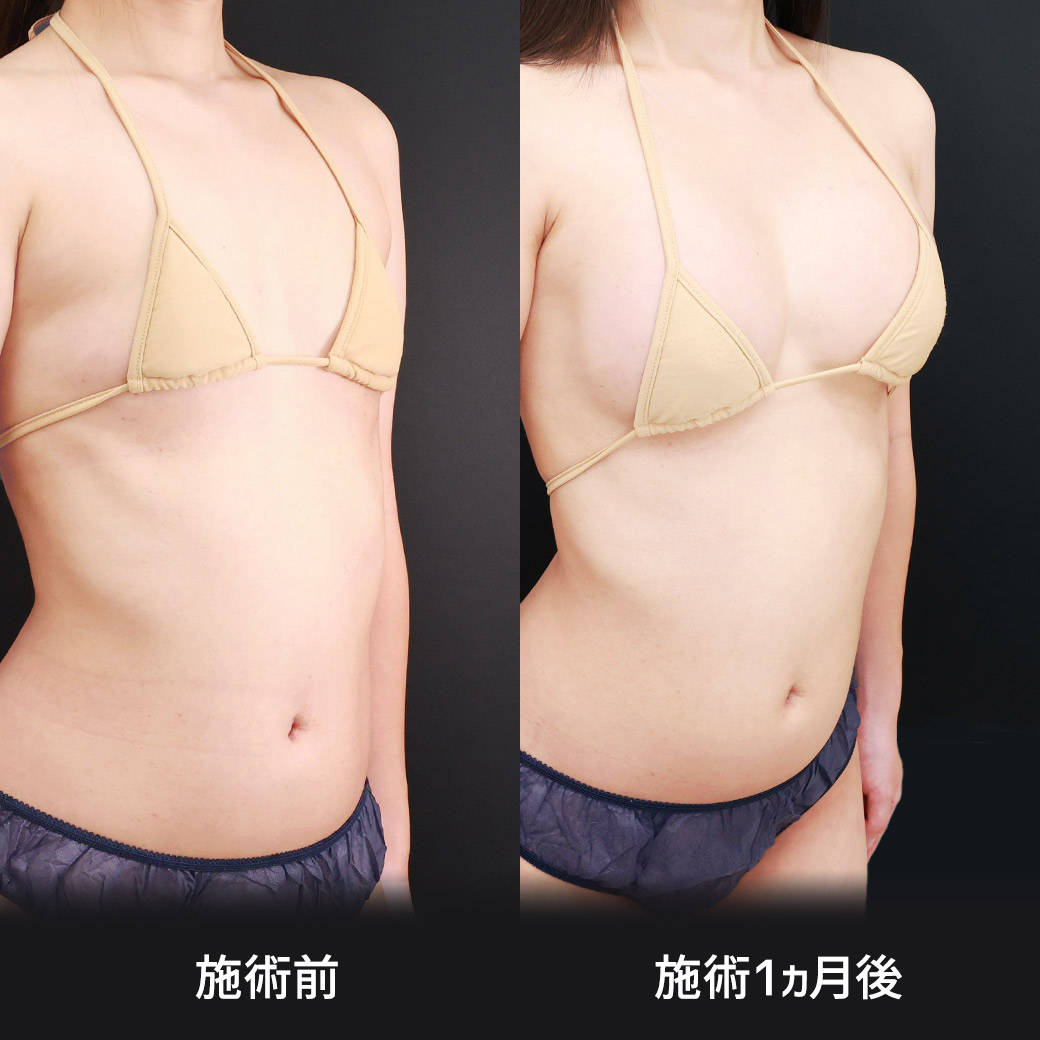 シリコンバッグ豊胸(人工乳腺バッグ)の症例写真 施術前後