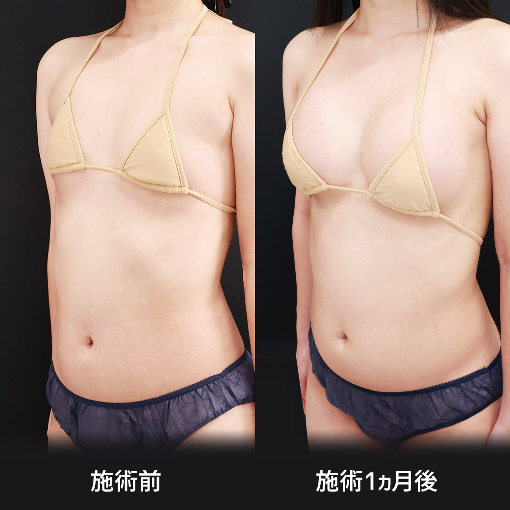 シリコンバッグ豊胸(人工乳腺バッグ)の症例写真 施術前後
