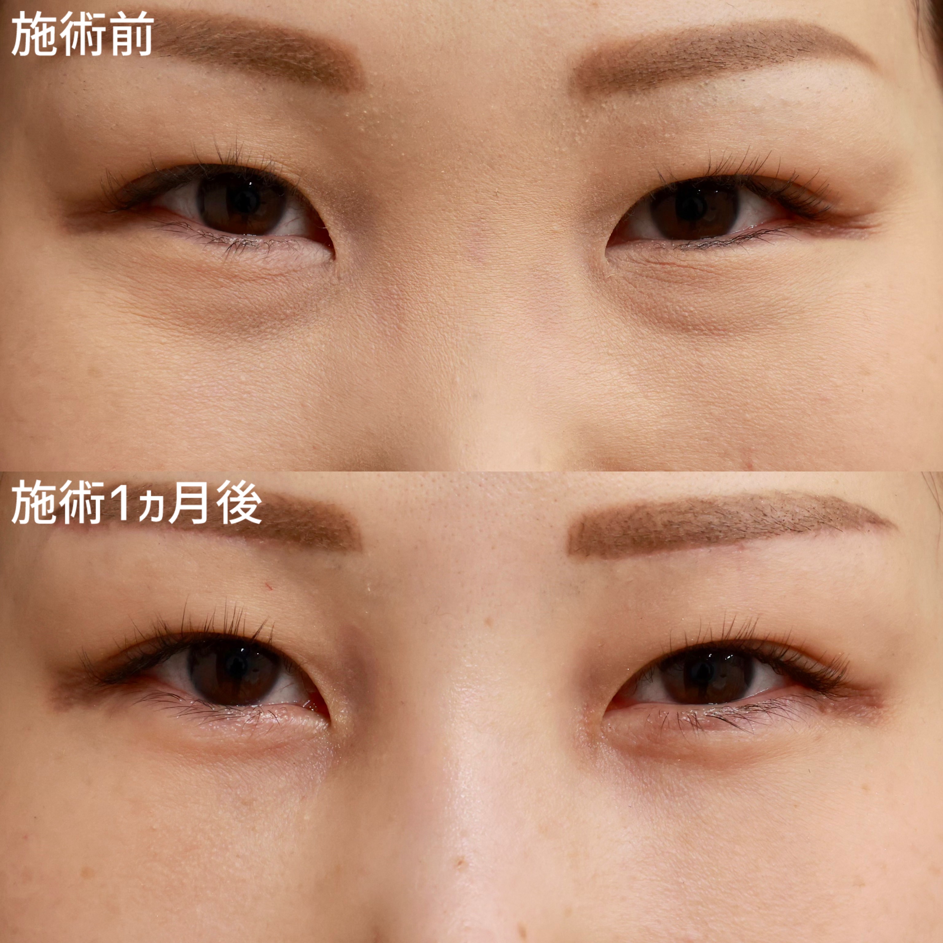 下眼瞼脱脂術（目の下のたるみ取り・目の下の脂肪ふくらみ取り）の症例写真 施術前後 