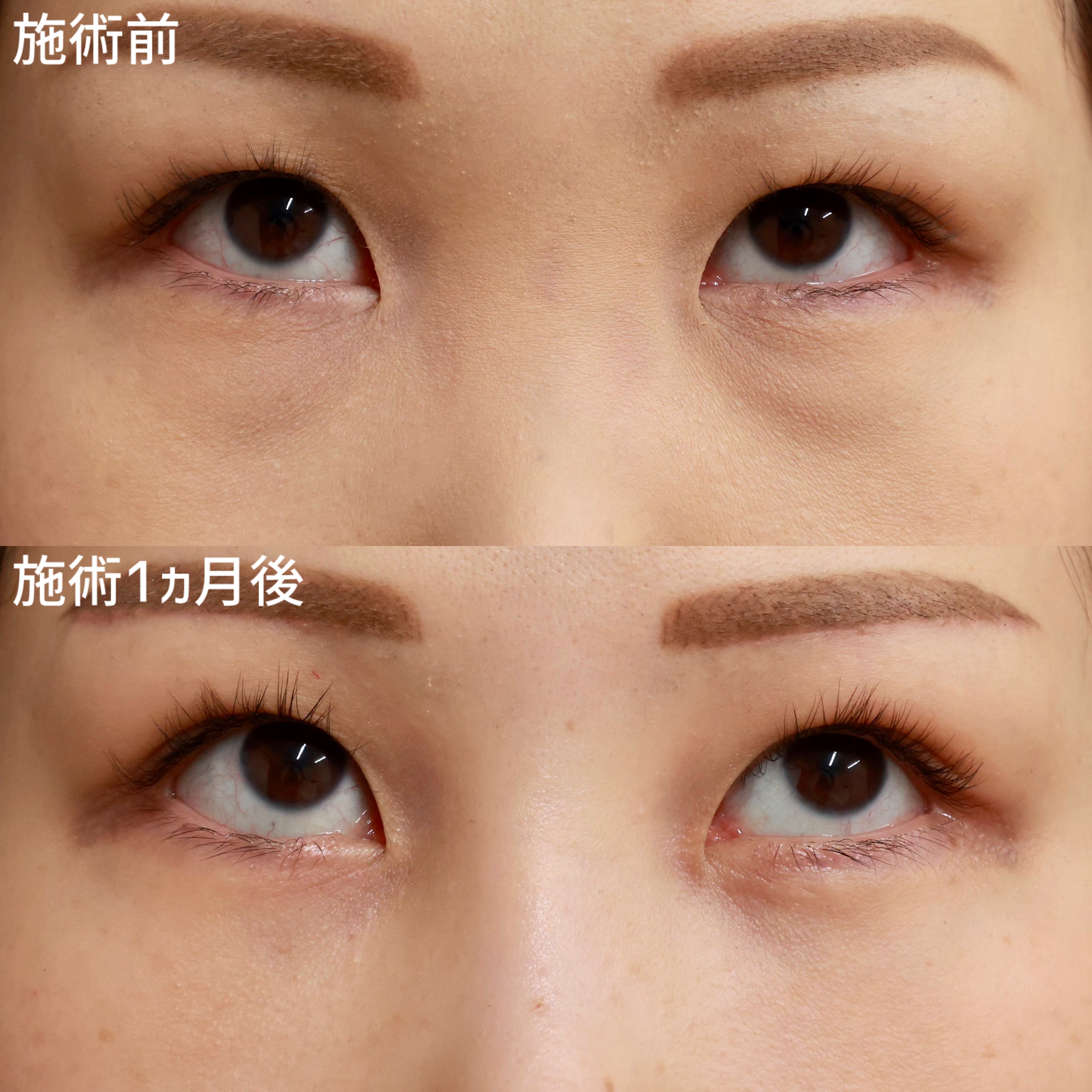 下眼瞼脱脂術（目の下のたるみ取り・目の下の脂肪ふくらみ取り）の症例写真 施術前後 