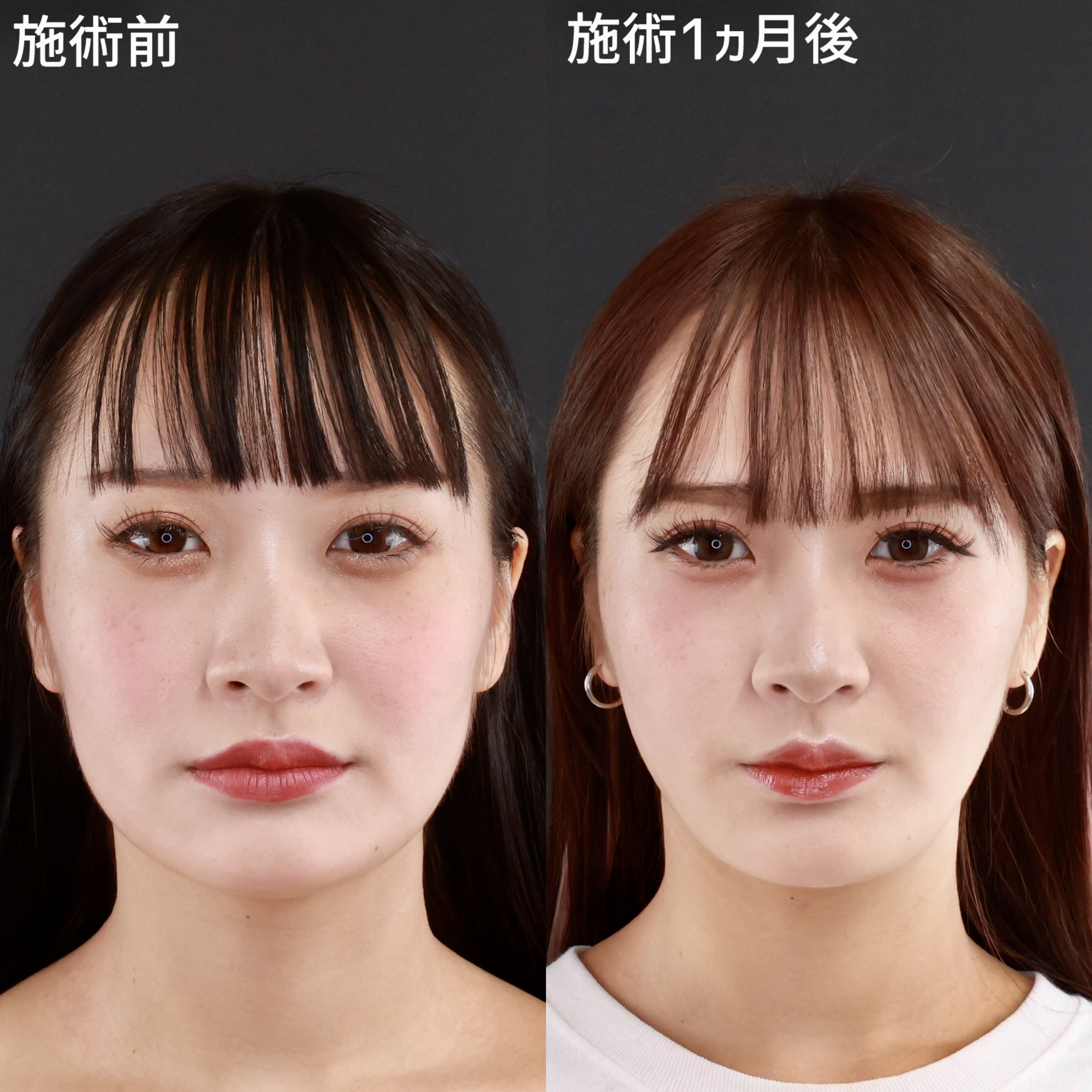 【小顔整形】お顔の余白をなくしてナチュラルに垢抜け