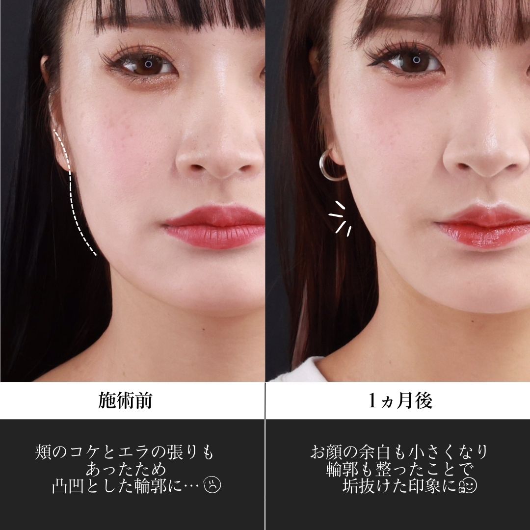 TAC式 ツヤ肌コラーゲンリフト®/エラボトックス注射の症例写真 施術前後 