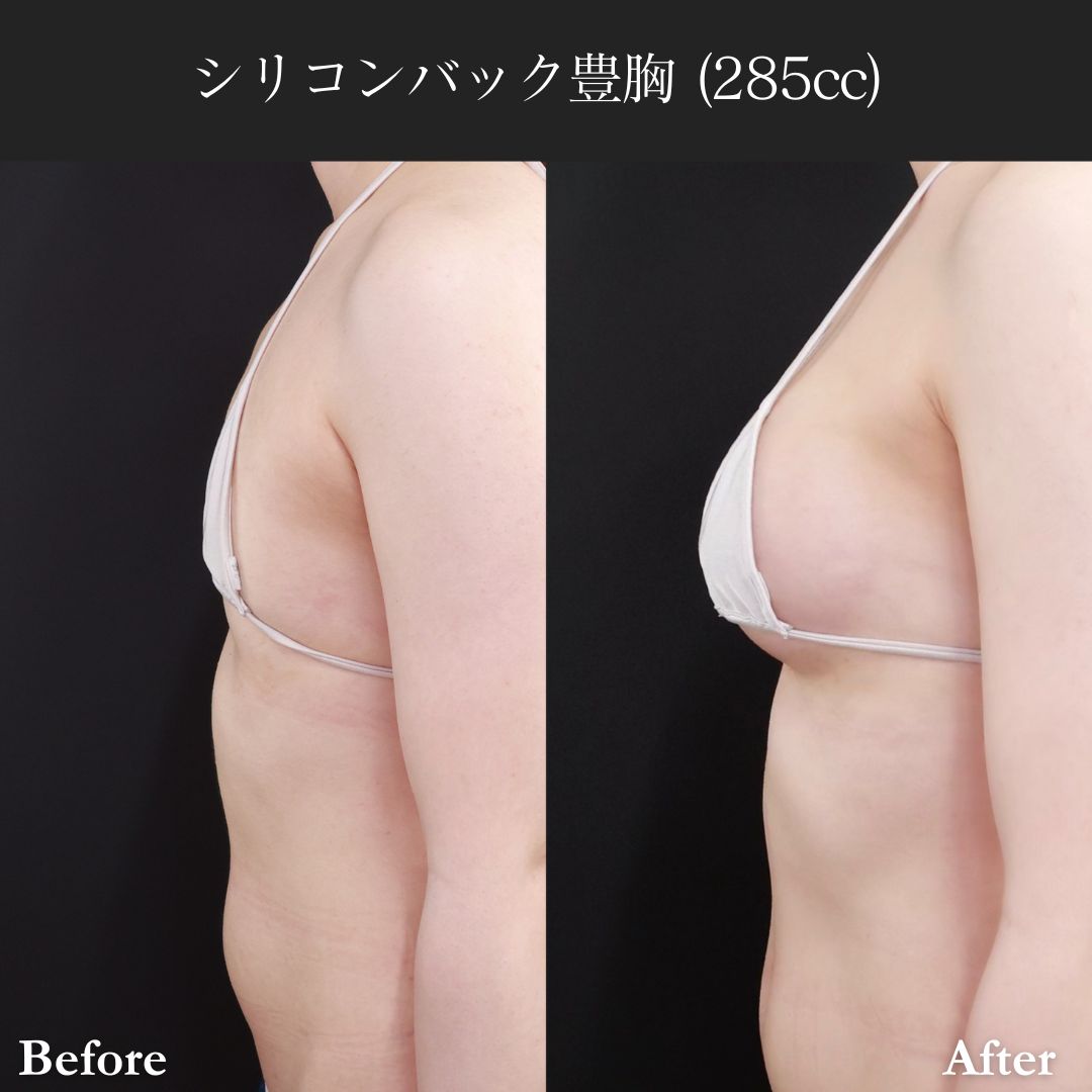シリコンバッグ豊胸（人工乳腺バッグ）の症例写真 施術前後 