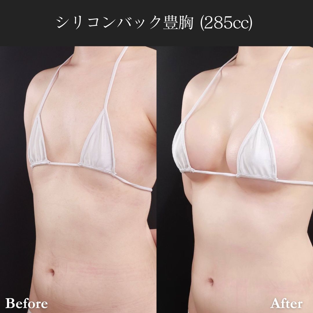 シリコンバッグ豊胸（人工乳腺バッグ）の症例写真 施術前後 