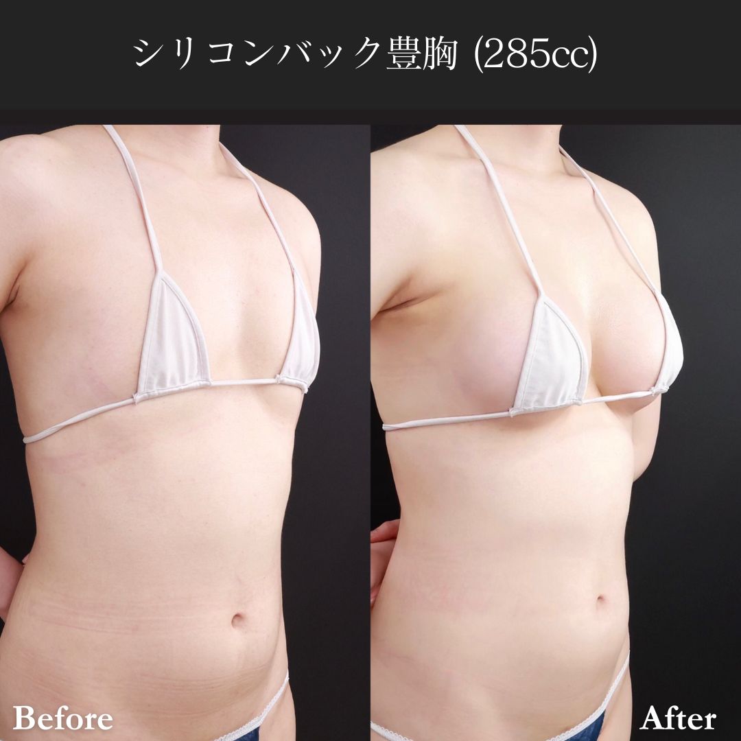 シリコンバッグ豊胸（人工乳腺バッグ）の症例写真 施術前後 
