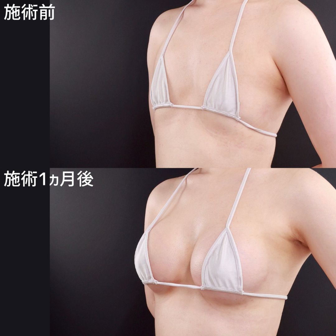 理想なバストで前向きな自分になれた【シリコンバッグ豊胸】