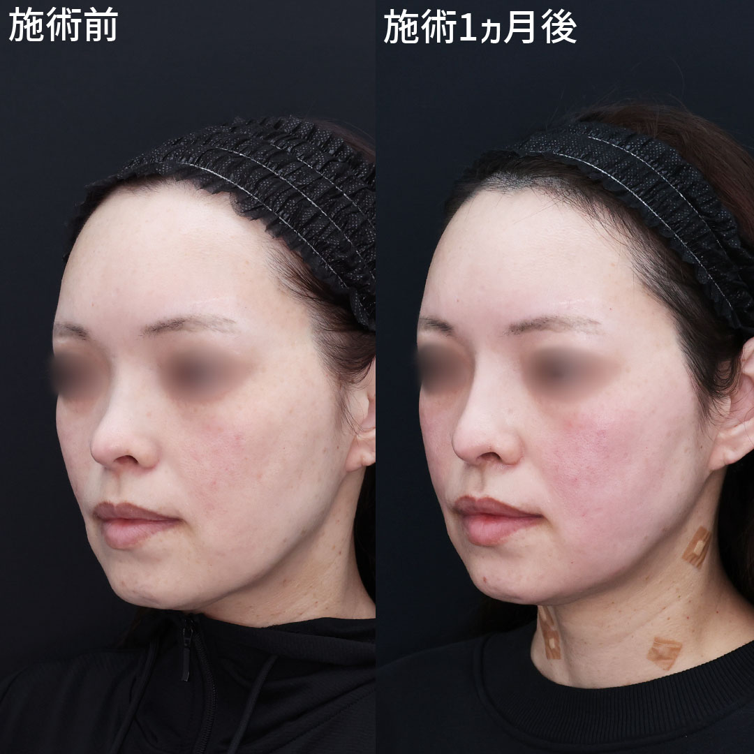 隆鼻術(プロテーゼ・自家組織)の症例写真 施術前後