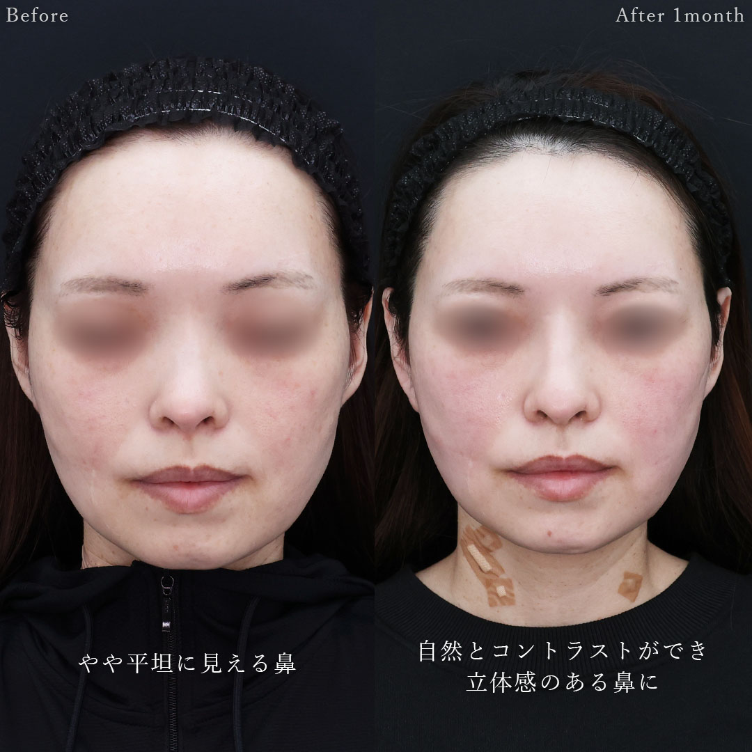 隆鼻術(プロテーゼ・自家組織)の症例写真 施術前後