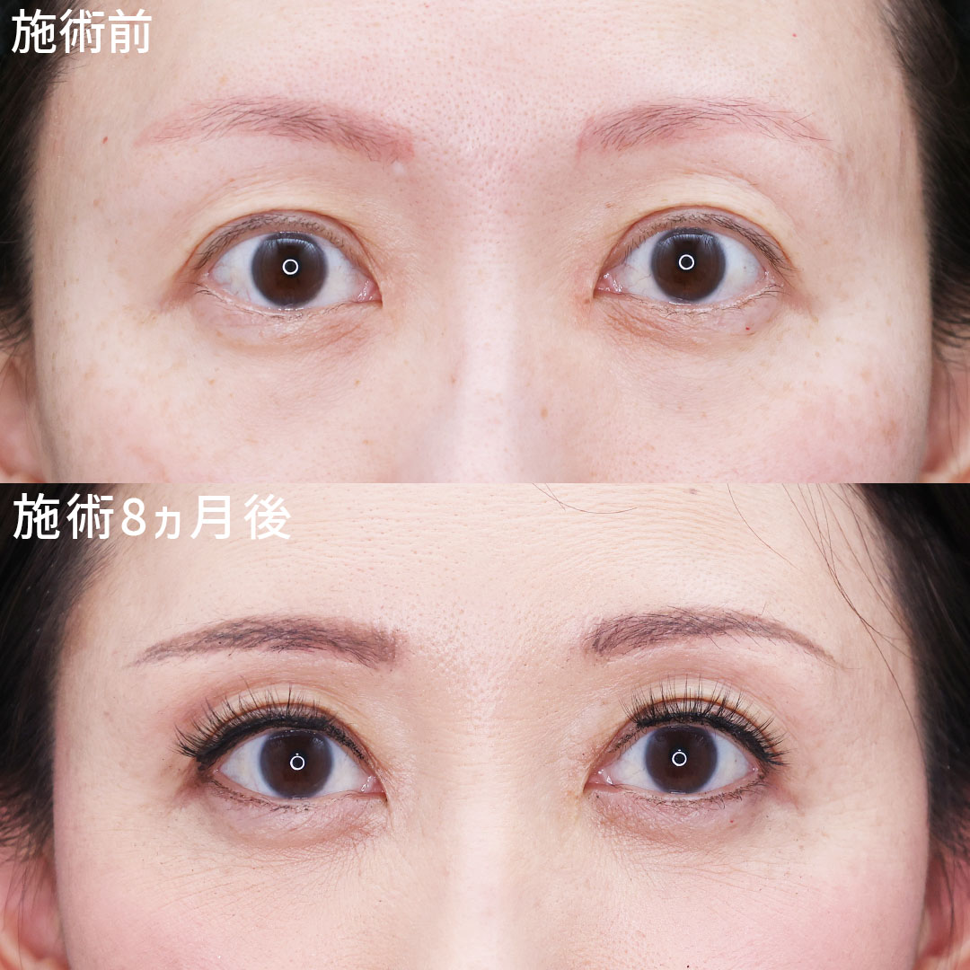 眉毛下切開術/下眼瞼切開術(クマ・たるみとり)の症例写真 施術前後