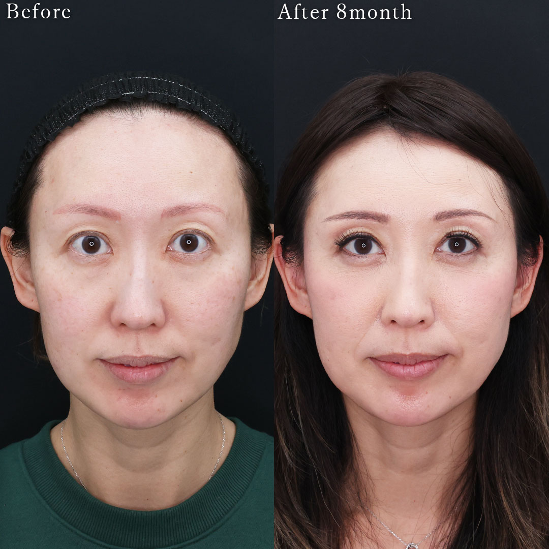 眉毛下切開術/下眼瞼切開術(クマ・たるみとり)の症例写真 施術前後