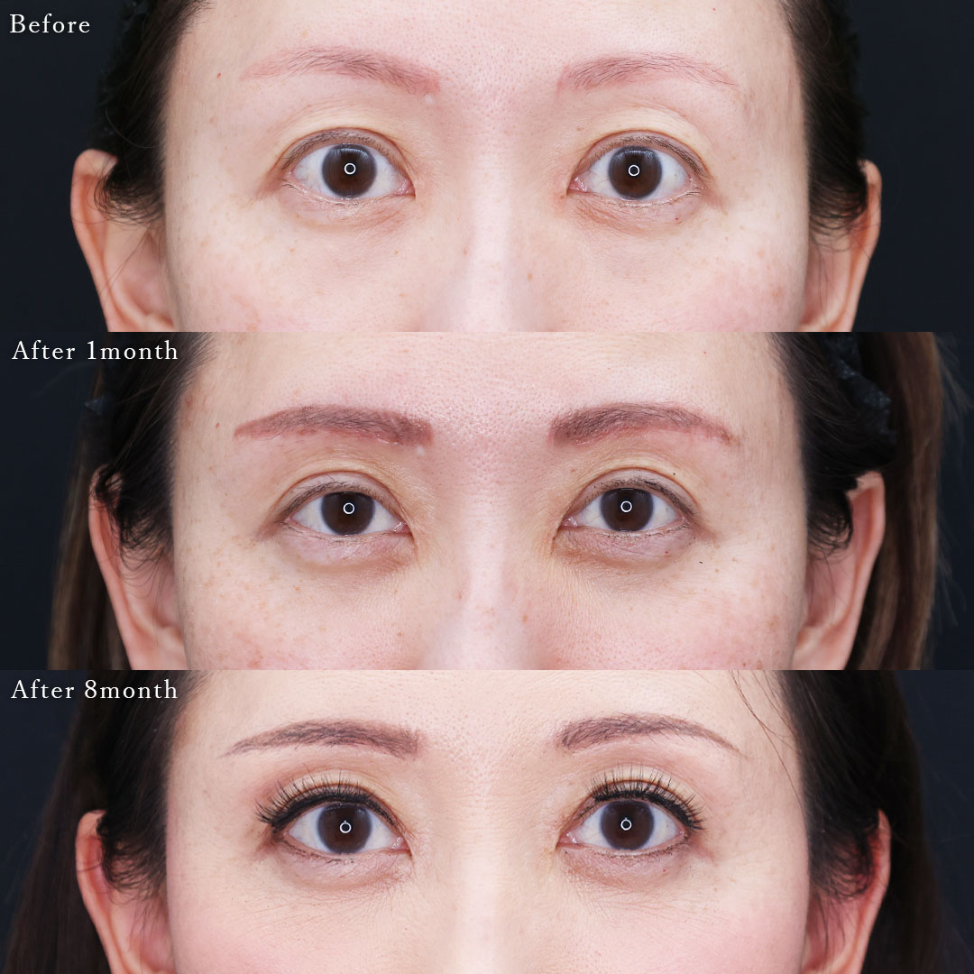 眉毛下切開術/下眼瞼切開術(クマ・たるみとり)の症例写真 施術前後