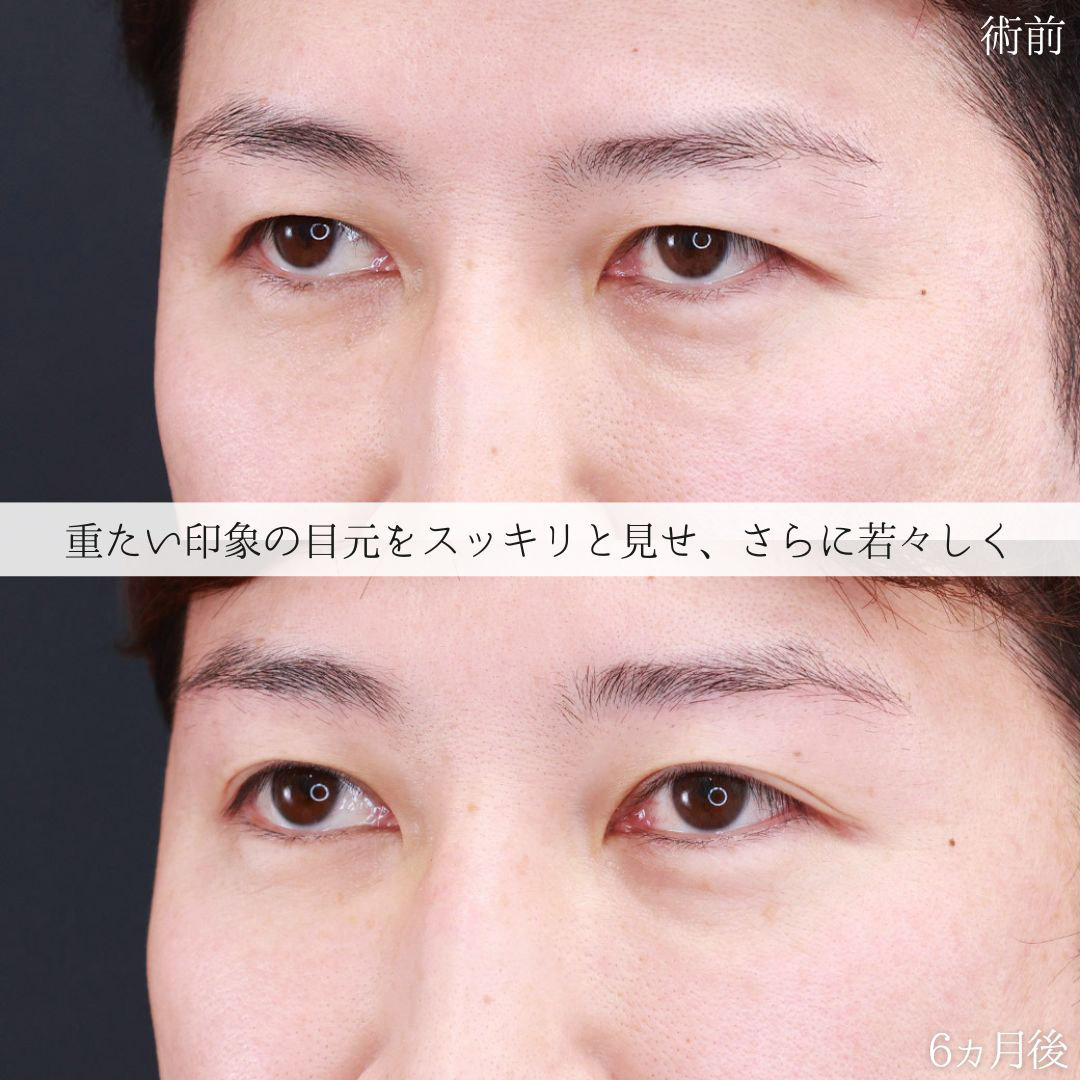 眉毛下切開術の症例写真 施術前後