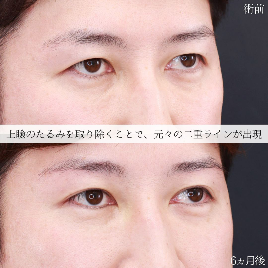 眉毛下切開術の症例写真 施術前後