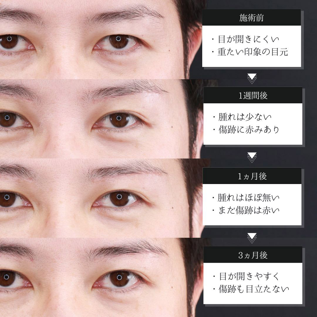 眉毛下切開術の症例写真 施術前後