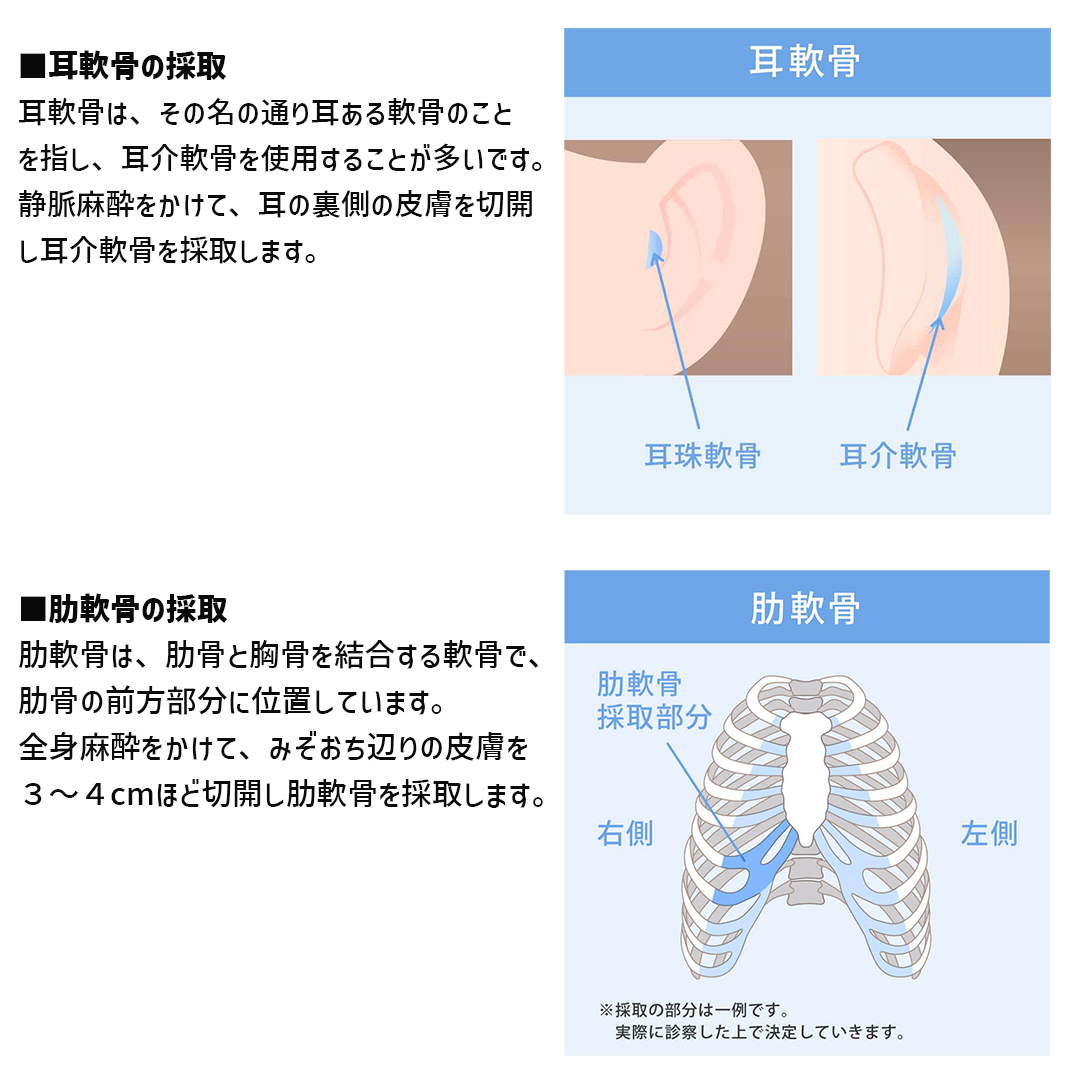 隆鼻術(プロテーゼ・自家組織)/鼻中隔延長術/鼻尖形成・鼻尖縮小の症例写真 施術前後