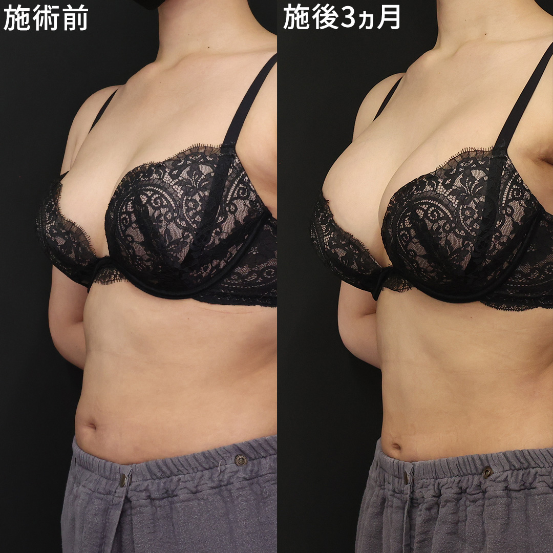 垂れた胸が…お椀型の美胸に! [シリコンバック豊胸]