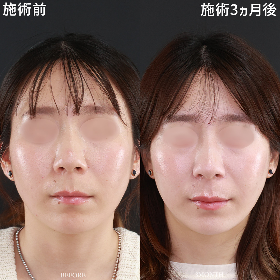 ナチュラルに美しい”理想の小鼻縮小術”